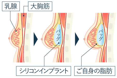 ハイブリッド豊胸（乳腺下法の場合）
